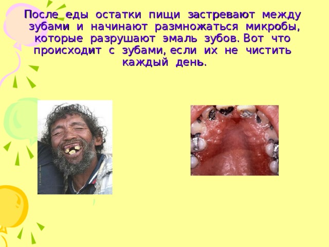 После еды остатки пищи застревают между зубами и начинают размножаться микробы, которые разрушают эмаль зубов. Вот что происходит с зубами, если их не чистить каждый день. 