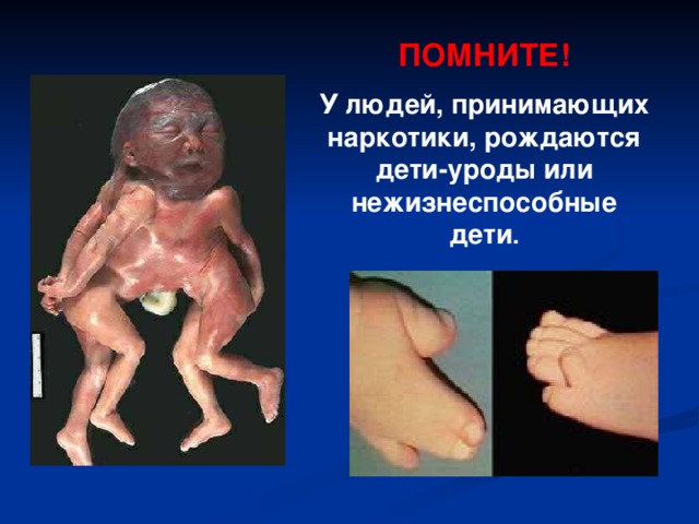 ПОМНИТЕ! У людей, принимающих наркотики, рождаются дети-уроды или нежизнеспособные дети .