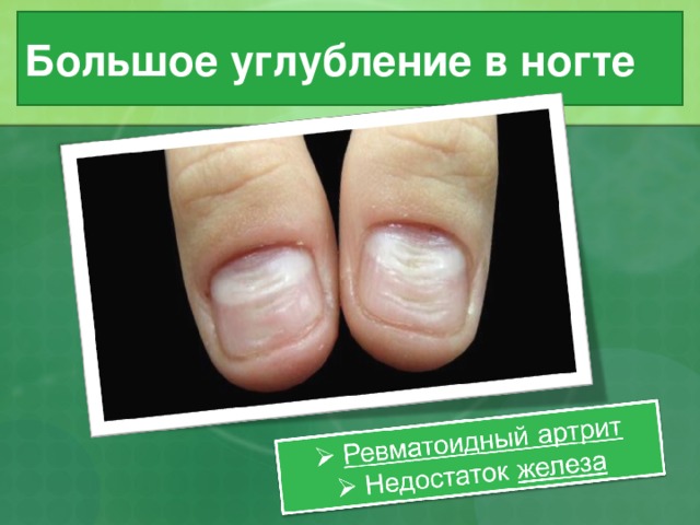 Большое углубление в ногте