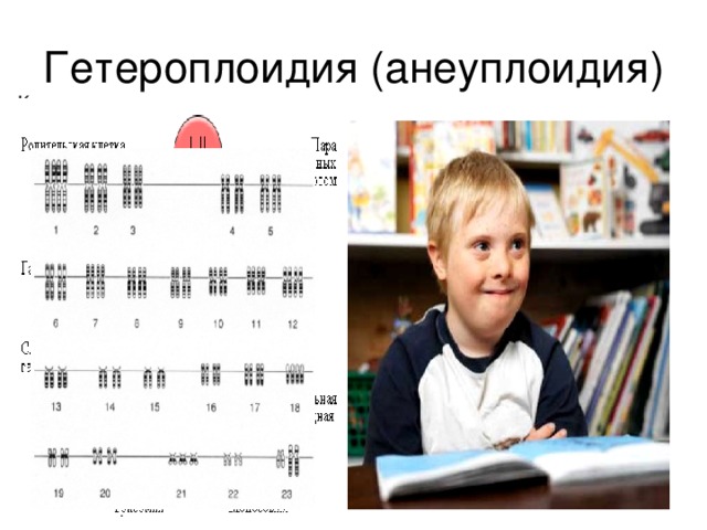 Гетероплоидия (анеуплоидия)  Кариотип мужчины, страдающего синдромом  Дауна .  