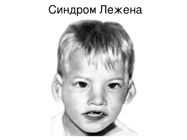  Синдром Лежена  