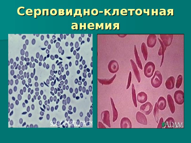Серповидно-клеточная анемия  