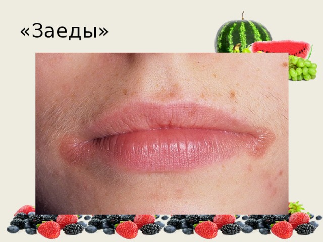 «Заеды» 