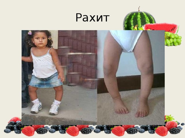 Рахит 