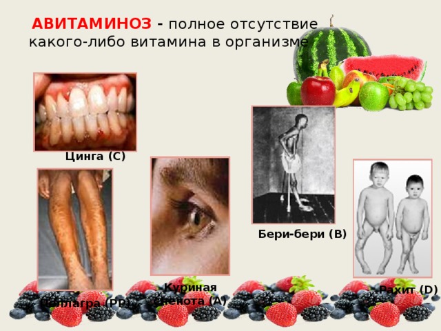  АВИТАМИНОЗ - полное отсутствие какого-либо витамина в организме   Цинга (С) Бери-бери (В) Куриная слепота (А) Рахит (D) Пеллагра (РР) 