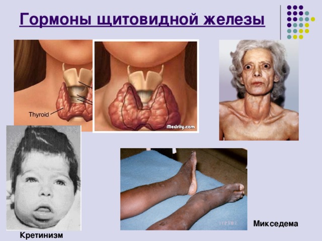 Гормоны щитовидной железы Микседема Кретинизм 