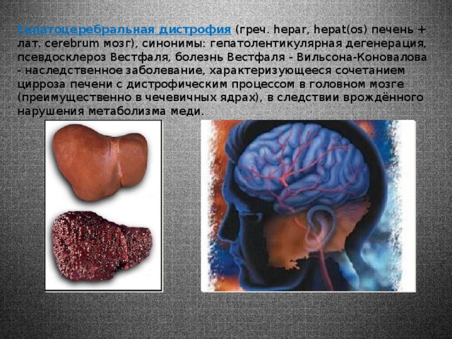 Гепатоцеребральная дистрофия (греч. hepar, hepat(os) печень + лат. cerebrum мозг), синонимы: гепатолентикулярная дегенерация, псевдосклероз Вестфаля, болезнь Вестфаля - Вильсона-Коновалова - наследственное заболевание, характеризующееся сочетанием цирроза печени с дистрофическим процессом в головном мозге (преимущественно в чечевичных ядрах), в следствии врождённого нарушения метаболизма меди. 
