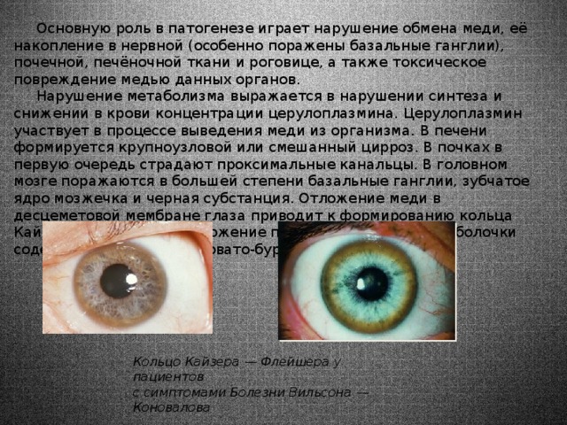  Основную роль в патогенезе играет нарушение обмена меди, её накопление в нервной (особенно поражены базальные ганглии), почечной, печёночной ткани и роговице, а также токсическое повреждение медью данных органов.  Нарушение метаболизма выражается в нарушении синтеза и снижении в крови концентрации церулоплазмина. Церулоплазмин участвует в процессе выведения меди из организма. В печени формируется крупноузловой или смешанный цирроз. В почках в первую очередь страдают проксимальные канальцы. В головном мозге поражаются в большей степени базальные ганглии, зубчатое ядро мозжечка и черная субстанция. Отложение меди в десцеметовой мембране глаза приводит к формированию кольца Кайзера-Флейшера — отложение по периферии роговой оболочки содержащего медь зеленовато-бурого пигмента Кольцо Кайзера — Флейшера у пациентов с симптомами Болезни Вильсона — Коновалова 