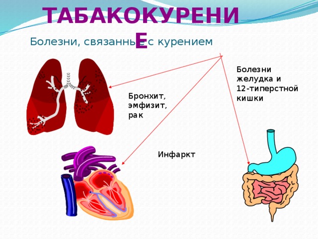 табакокурение Болезни, связанные с курением Болезни желудка и 12-типерстной кишки Бронхит, эмфизит, рак Инфаркт 