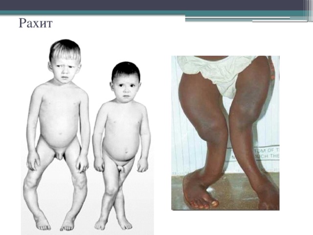Рахит 