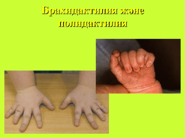 Даун синдромы 