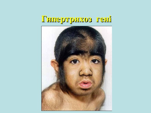 Шерешевский – Тернер синдромы 