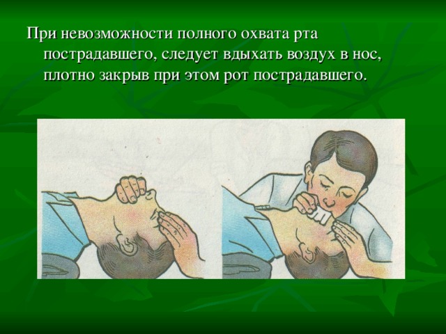 При невозможности полного охвата рта пострадавшего, следует вдыхать воздух в нос, плотно закрыв при этом рот пострадавшего. 