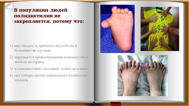 В популяции людей полидактилия не закрепляется, потому что:    шестипалость приносит неудобства в большинстве случаев; нарушается кровообращение конечностей и мелкая моторика; в гомозиготном состоянии особи летальны; нет отбора против нормального количества пальцев. 
