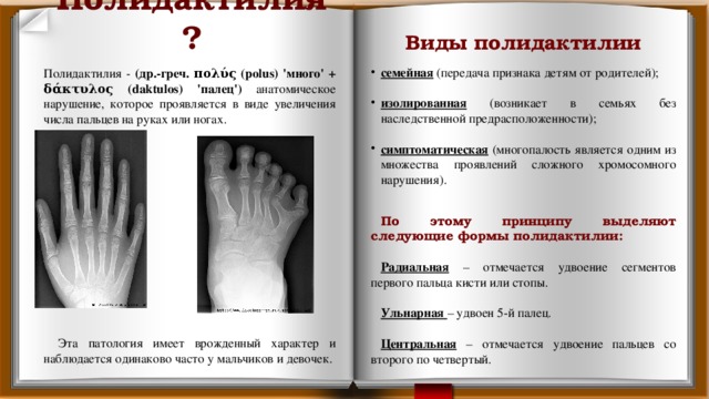  Виды полидактилии   семейная (передача признака детям от родителей); изолированная (возникает в семьях без наследственной предрасположенности);  симптоматическая (многопалость является одним из множества проявлений сложного хромосомного нарушения).  По этому принципу выделяют следующие формы полидактилии:  Радиальная – отмечается удвоение сегментов первого пальца кисти или стопы. Ульнарная – удвоен 5-й палец. Центральная – отмечается удвоение пальцев со второго по четвертый. Полидактилия? Полидактилия - (др.-греч. πολύς (polus) 'много' + δάκτυλος (daktulos) 'палец') анатомическое нарушение, которое проявляется в виде увеличения числа пальцев на руках или ногах. Эта патология имеет врожденный характер и наблюдается одинаково часто у мальчиков и девочек. 