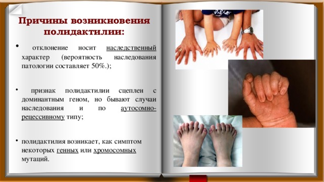 Причины возникновения полидактилии:  отклонение носит наследственный характер (вероятность наследования патологии составляет 50%.);  признак полидактилии сцеплен с доминантным геном, но бывают случаи наследования и по аутосомно-рецессивному типу; полидактилия возникает, как симптом некоторых генных или хромосомных мутаций.   