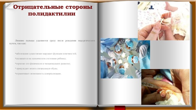 Отрицательные стороны полидактилии Лишние пальцы удаляются сразу после рождения хирургическим путем, так как: заболевание существенно нарушает функции конечностей; сказывается на психическом состоянии ребенка; тормозит его физическое и эмоциональное развитие;  принуждает носить специальную обувь; ограничивает возможность самореализации. 