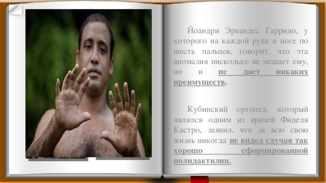  Йоандри Эрнандес Гарридо, у которого на каждой руке и ноге по шесть пальцев, говорит, что эта аномалия нисколько не мешает ему, но и не дает никаких преимуществ .  Кубинский ортопед, который являлся одним из врачей Фиделя Кастро, заявил, что за всю свою жизнь никогда не видел случая так хорошо сформированной полидактилии.   Эрнандес Гарридо: человек с 24 пальцами 