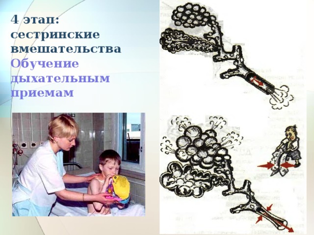 4 этап: сестринские вмешательства  Обучение дыхательным приемам 