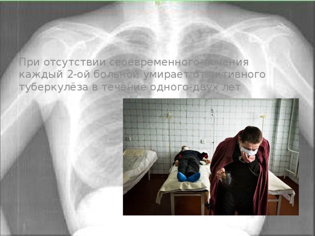 При отсутствии своевременного лечения каждый 2-ой больной умирает от активного туберкулёза в течение одного-двух лет 