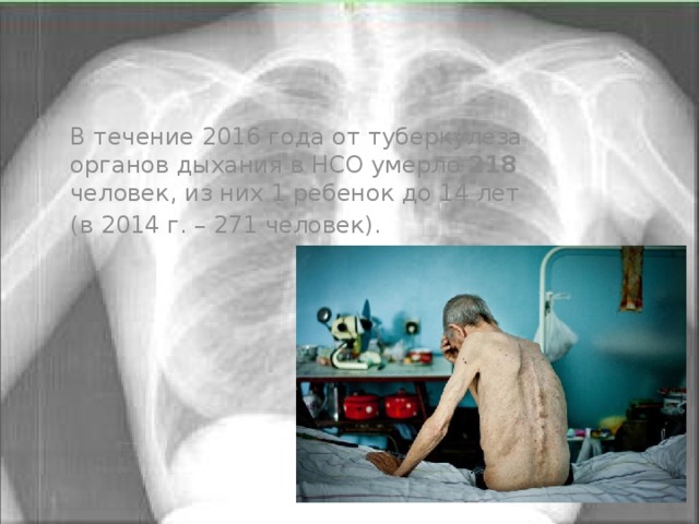 В течение 2016 года от туберкулеза органов дыхания в НСО умерло 218 человек, из них 1 ребенок до 14 лет (в 2014 г. – 271 человек). 