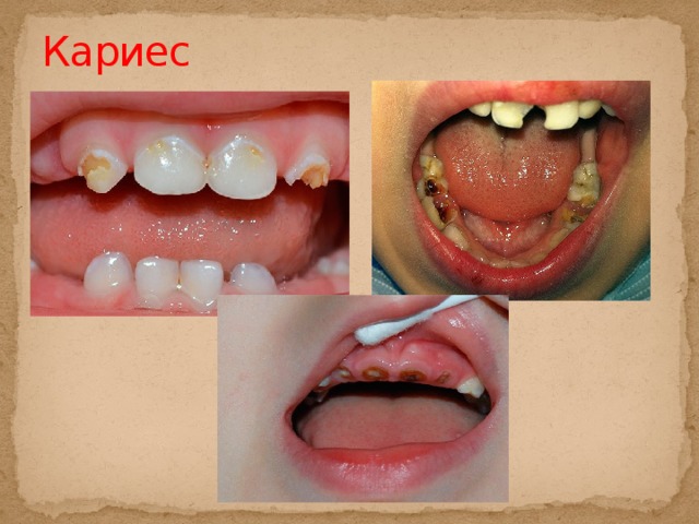Кариес  