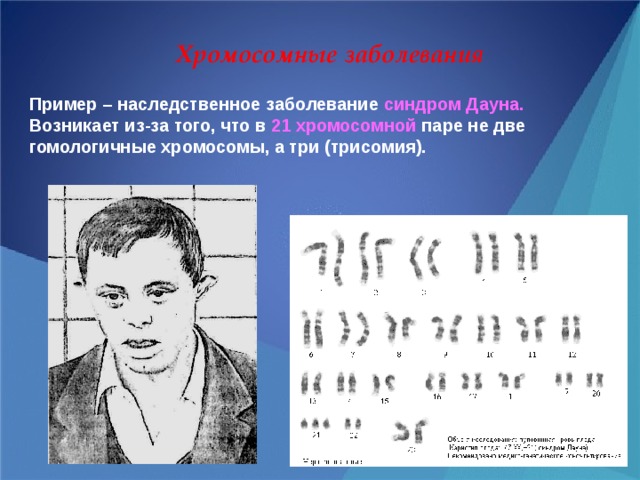 Хромосомные заболевания Пример – наследственное заболевание синдром Дауна. Возникает из-за того, что в 21 хромосомной паре не две гомологичные хромосомы, а три (трисомия). 