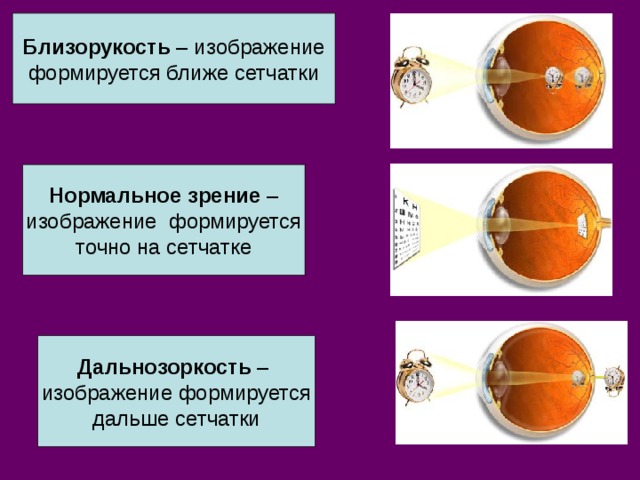 Близорукость – изображение формируется ближе сетчатки Нормальное зрение – изображение формируется точно на сетчатке Дальнозоркость – изображение формируется дальше сетчатки 