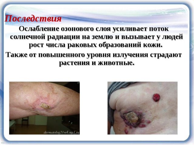 Последствия Ослабление озонового слоя усиливает поток солнечной радиации на землю и вызывает у людей рост числа раковых образований кожи. Также от повышенного уровня излучения страдают растения и животные. 