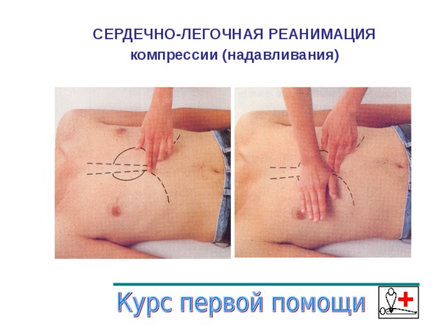 СЕРДЕЧНО-ЛЕГОЧНАЯ РЕАНИМАЦИЯ компрессии (надавливания)