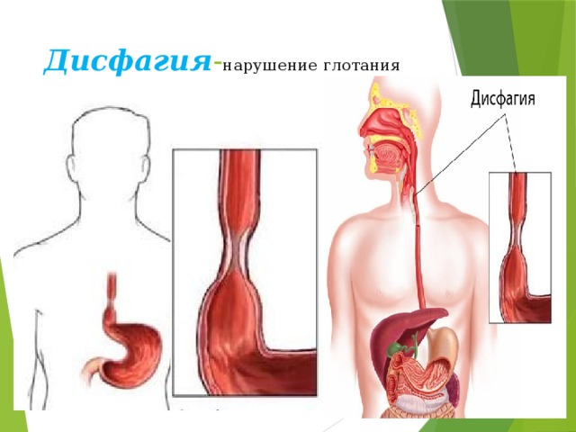 Дисфагия - нарушение глотания 