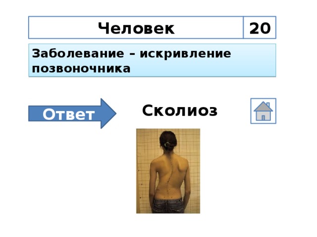 Человек 20 Заболевание – искривление позвоночника Ответ Сколиоз