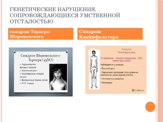 Генетические нарушения, сопровождающиеся умственной отсталостью синдром Тернера-Шерешевского Синдром Клайнфельтера 