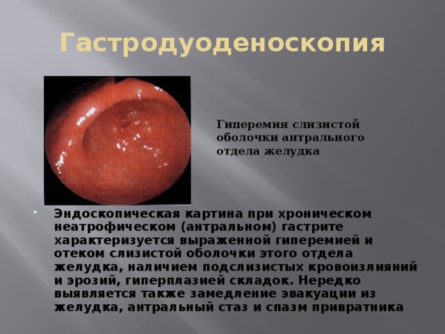 Гастродуоденоскопия Гиперемия слизистой оболочки антрального отдела желудка Эндоскопическая картина при хроническом неатрофическом (антральном) гастрите характеризуется выраженной гиперемией и отеком слизистой оболочки этого отдела желудка, наличием подслизистых кровоизлияний и эрозий, гиперплазией складок. Нередко выявляется также замедление эвакуации из желудка, антральный стаз и спазм привратника 
