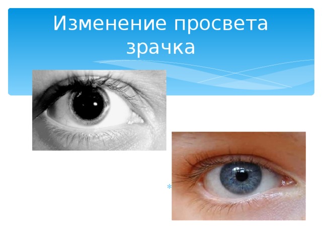 Изменение просвета зрачка шщ 