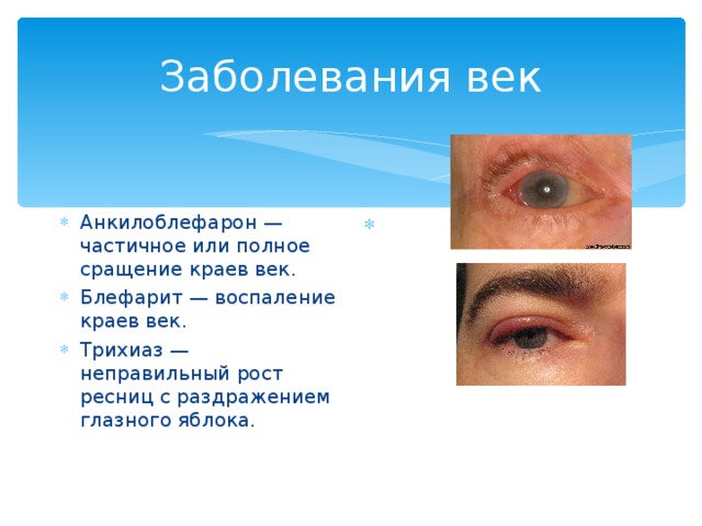 Заболевания век Анкилоблефарон — частичное или полное сращение краев век. Блефарит — воспаление краев век. Трихиаз — неправильный рост ресниц с раздражением глазного яблока. 