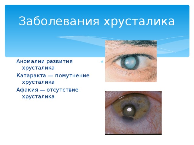 Заболевания хрусталика Аномалии развития хрусталика Катаракта — помутнение хрусталика Афакия — отсутствие хрусталика 