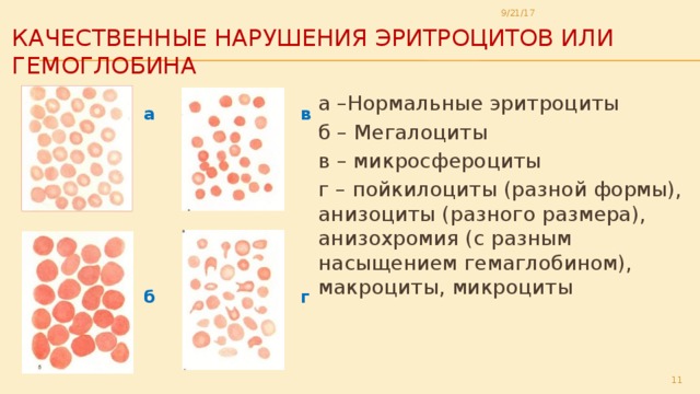 9/21/17 качественные нарушения эритроцитов или гемоглобина а –Нормальные эритроциты б – Мегалоциты в – микросфероциты г – пойкилоциты (разной формы), анизоциты (разного размера), анизохромия (с разным насыщением гемаглобином), макроциты, микроциты в а г б  
