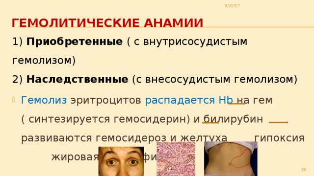 9/21/17 Гемолитические анамии 1) Приобретенные ( с внутрисосудистым гемолизом)  2) Наследственные (с внесосудистым гемолизом) Гемолиз эритроцитов распадается Hb на гем ( синтезируется гемосидерин) и билирубин развиваются гемосидероз и желтуха гипоксия жировая дистрофия   