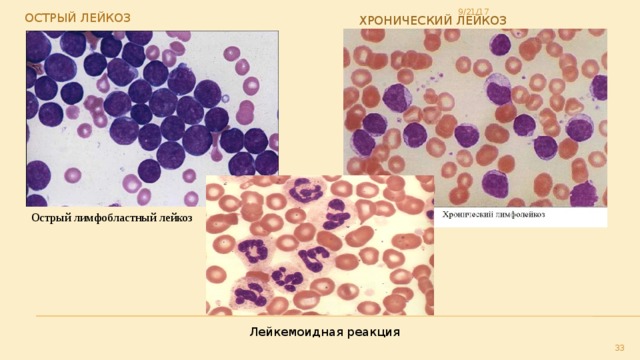 Острый лейкоз Хронический лейкоз 9/21/17 Острый лимфобластный лейкоз Лейкемоидная реакция 29 