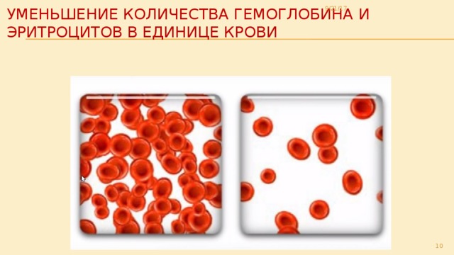 9/21/17 уменьшение количества гемоглобина и эритроцитов в единице крови    
