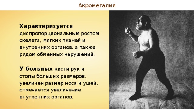 Акромегалия Характеризуется диспропорциональным ростом скелета, мягких тканей и внутренних органов, а также рядом обменных нарушений. У больных кисти рук и стопы больших размеров, увеличен размер носа и ушей, отмечается увеличение внутренних органов. 