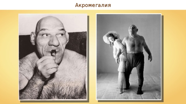 Акромегалия 
