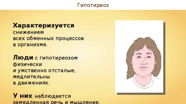 Гипотиреоз Характеризуется снижением всех обменных процессов в организме. Люди с гипотиреозом физически и умственно отсталые, медлительны в движениях. У них наблюдается замедленная речь и мышление, отмечается сонливость, зябкость. 