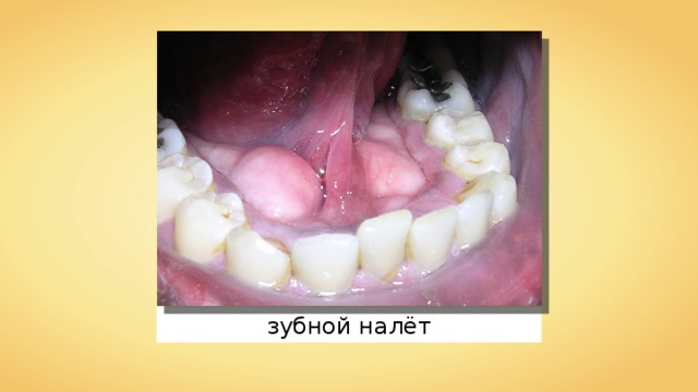 зубной налёт 