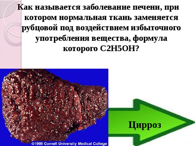 Как называется заболевание печени, при котором нормальная ткань заменяется рубцовой под воздействием избыточного употребления вещества, формула которого С2Н5ОН? Цирроз  