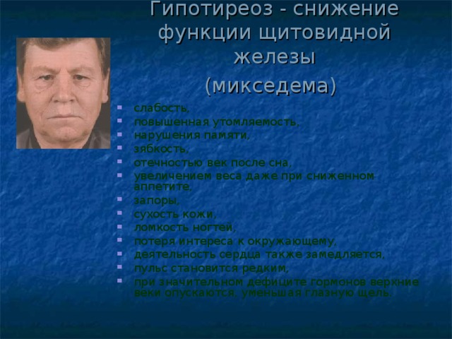 Гипотиреоз - с нижение функции щитовидной железы  (микседема)  слабость, повышенная утомляемость, нарушения памяти, зябкость, отечностью век после сна, увеличением веса даже при сниженном аппетите, запоры, сухость кожи, ломкость ногтей, потеря интереса к окружающему, деятельность сердца также замедляется, пульс становится редким, при значительном дефиците гормонов верхние веки опускаются, уменьшая глазную щель.   