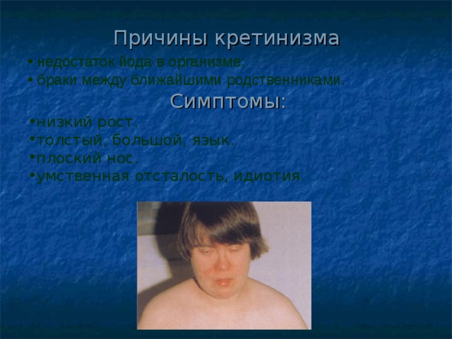 Причины кретинизма  недостаток йода в организме;  браки между ближайшими родственниками.  Симптомы: низкий рост. толстый, большой, язык. плоский нос. умственная отсталость, идиотия. 