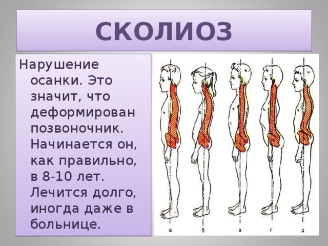 СКОЛИОЗ Нарушение осанки. Это значит, что деформирован позвоночник. Начинается он, как правильно, в 8-10 лет. Лечится долго, иногда даже в больнице. 