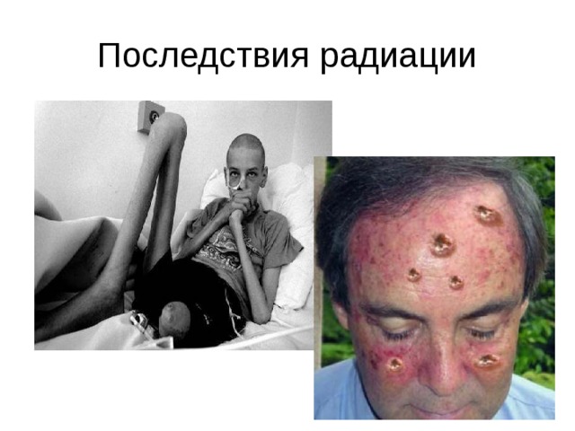 Последствия радиации 
